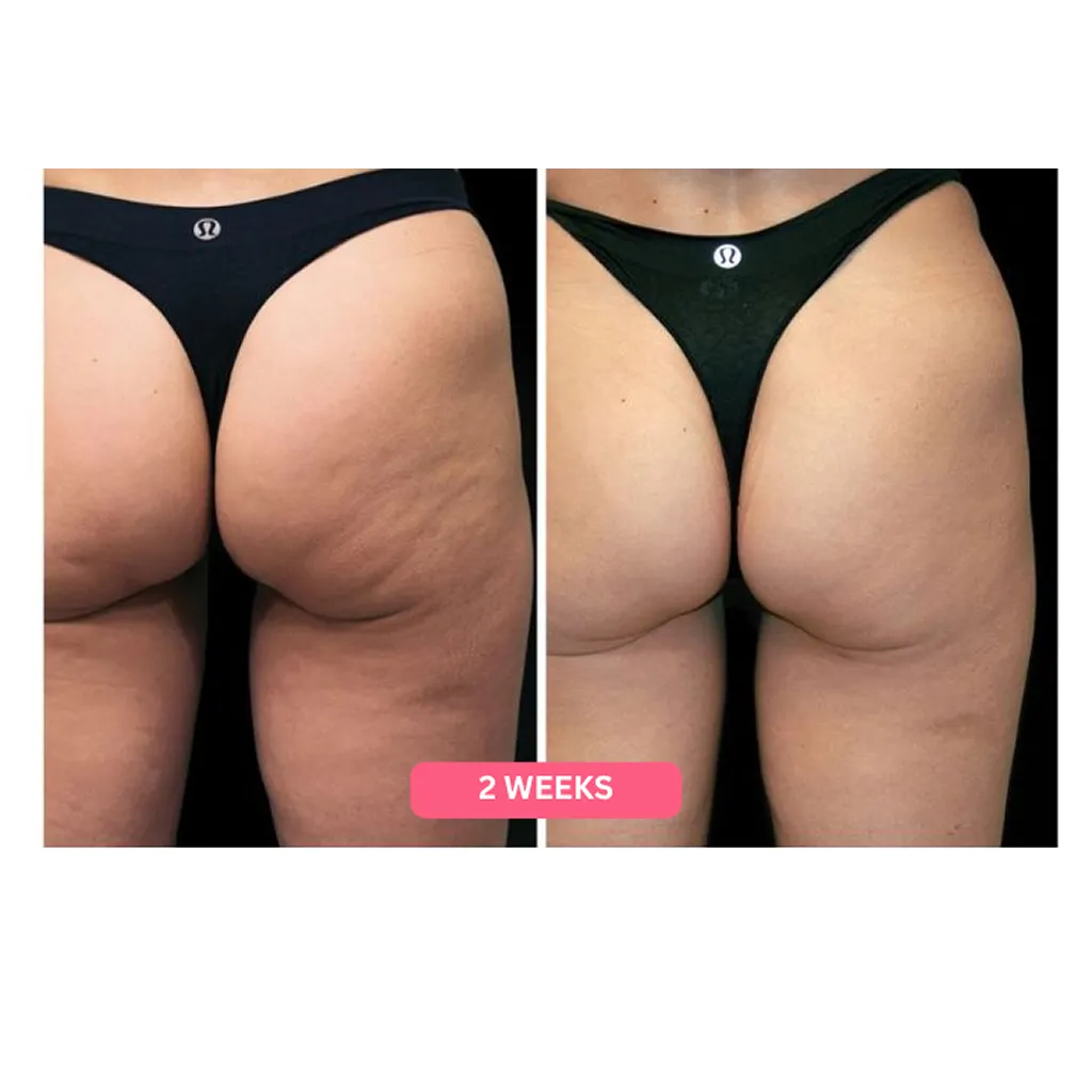 Herology Cellulite Relief Kit