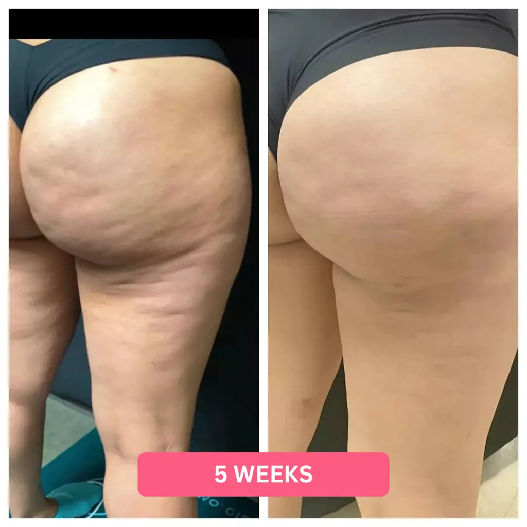 Herology Cellulite Relief Kit