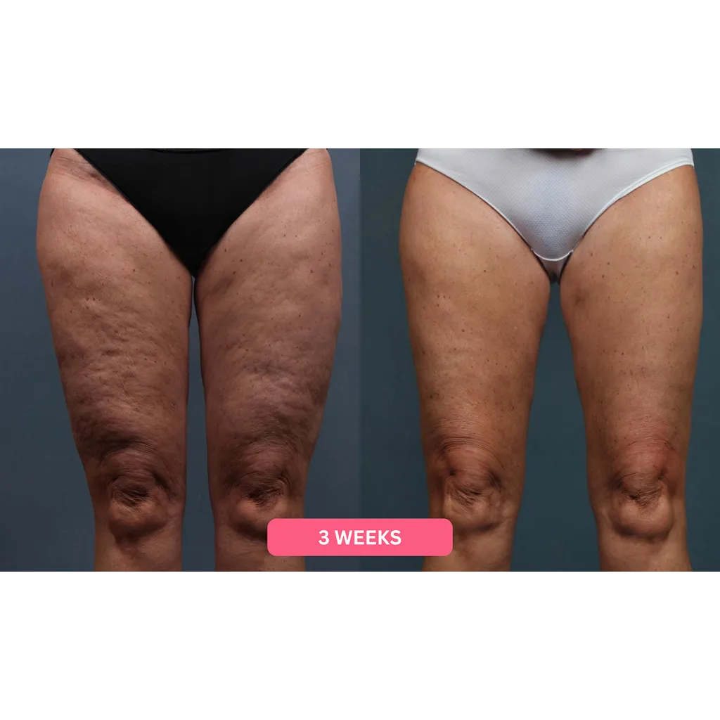 Herology Cellulite Relief Kit